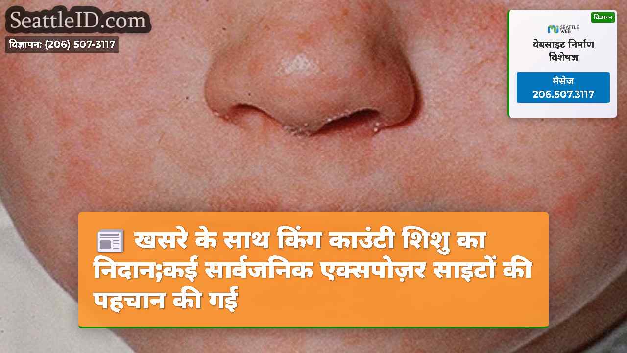 खसरे के साथ किंग काउंटी शिशु का निदान;कई