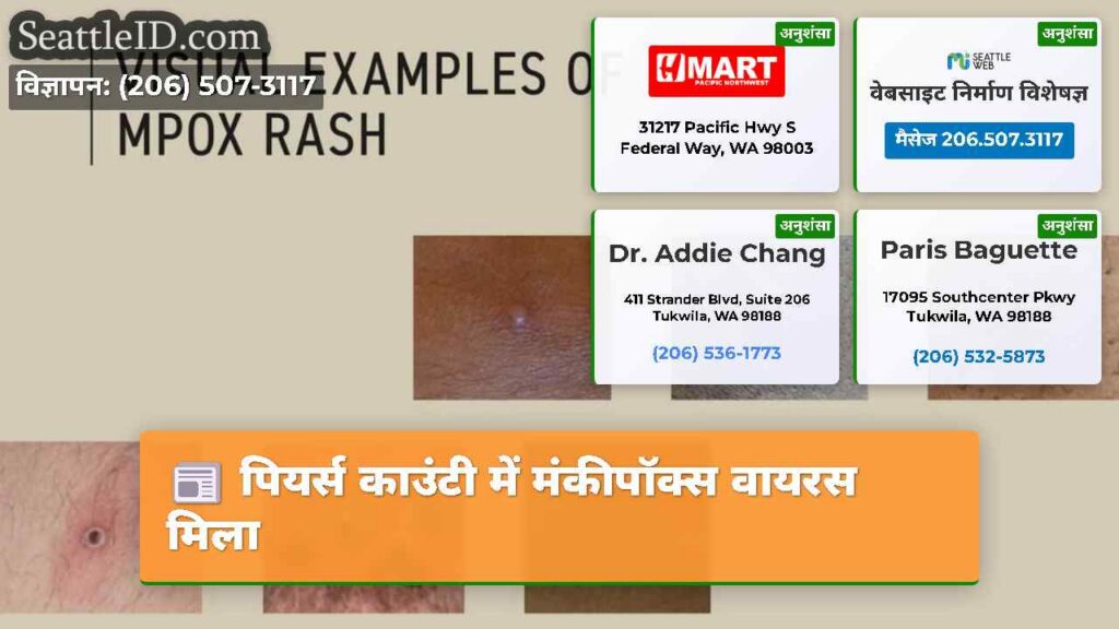 पियर्स काउंटी में मंकीपॉक्स वायरस मिला